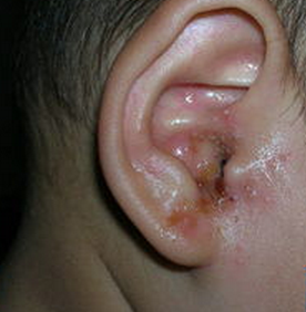 婴儿外耳道湿疹？