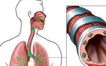 什么是阻塞性肺气肿