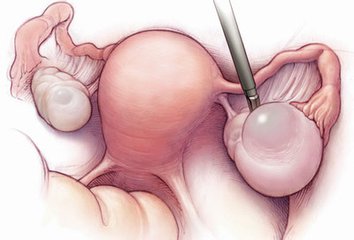 卵巢囊肿剥离术是否损伤卵巢
