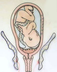 卵巢前置胎盘的常见问题