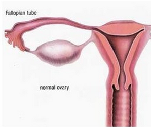 卵巢癌出血的原因有哪些
